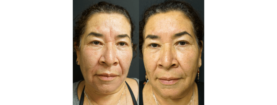 Laser Facial Results 2