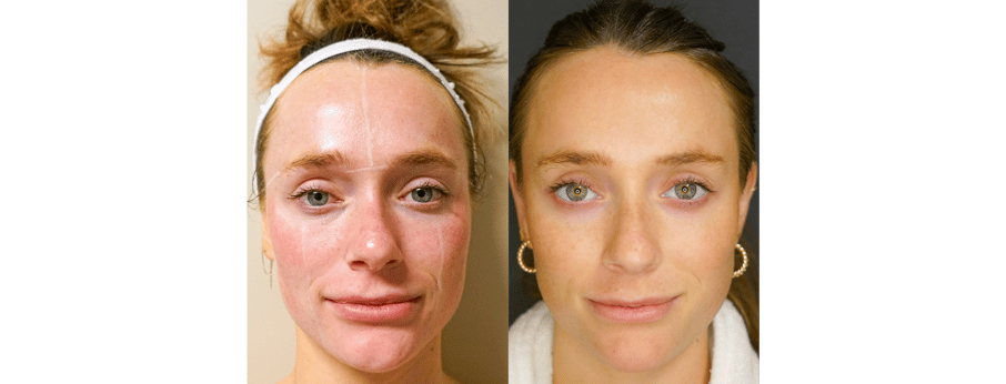 Laser Facial Results 3