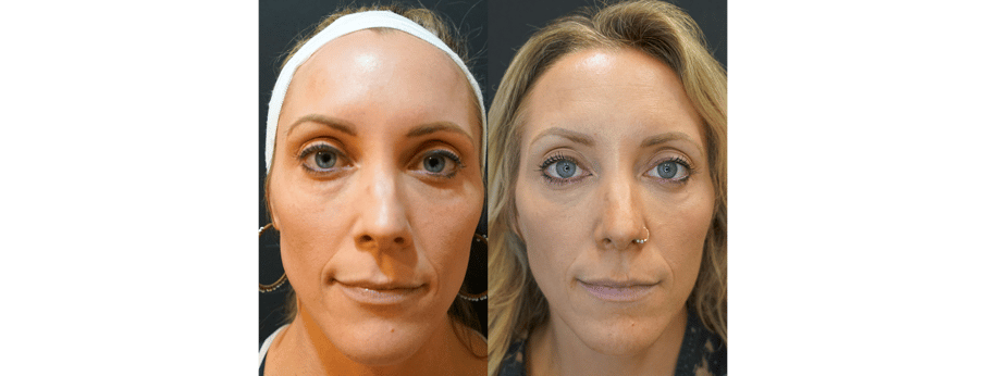 Laser Facial Results 1