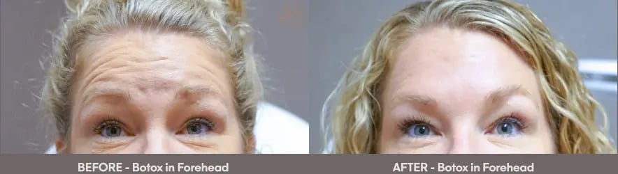 before_after_slider_botox1-1