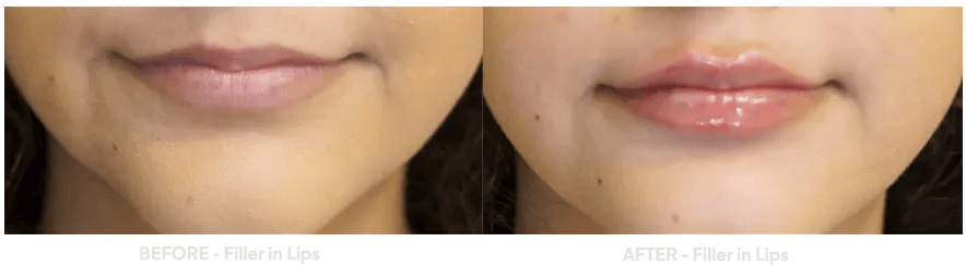 before_after_slider_lip_filler1