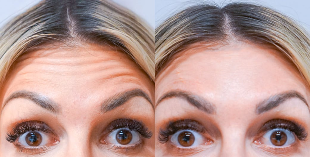 Before - and -Afer - Botox - 001