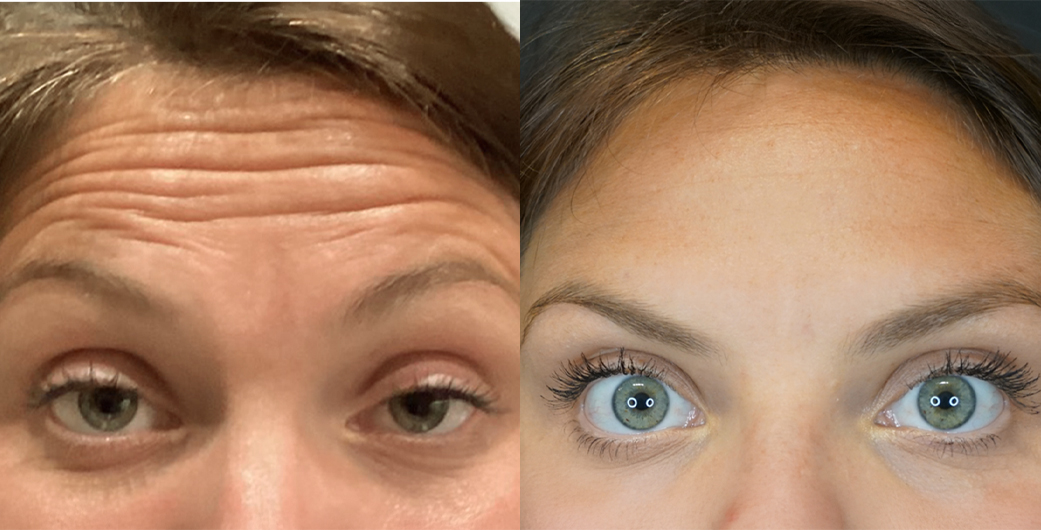 Before - and -Afer - Botox - 002
