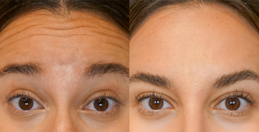 Before - and -Afer - Botox - 003