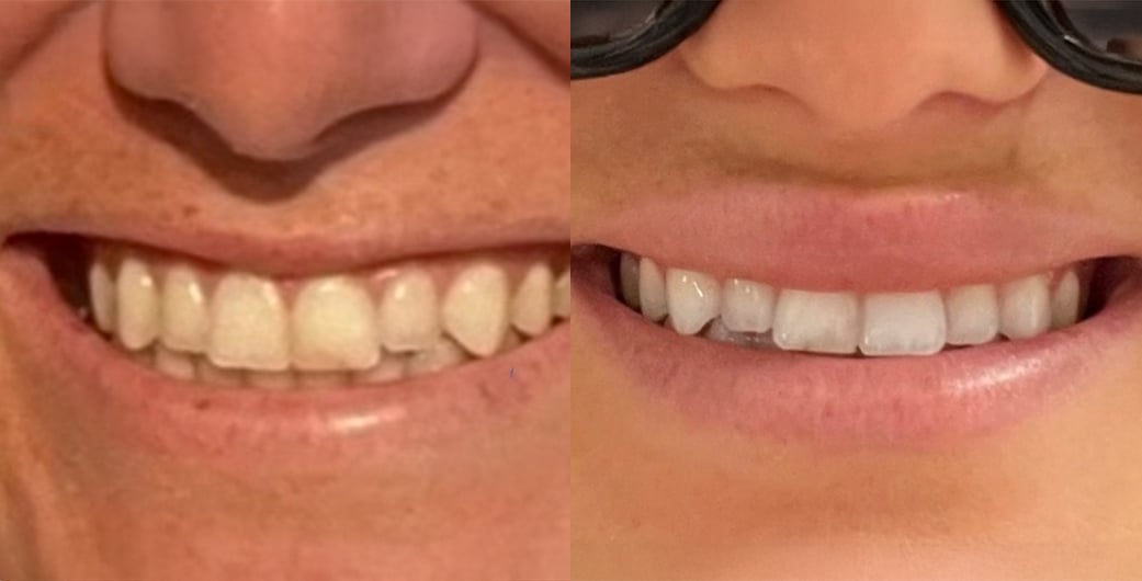 Before - and -Afer - Botox - 004