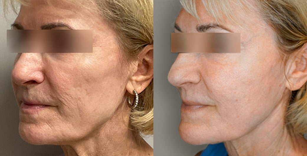 Morpheus8 Before and After Photos of Blonde Woman