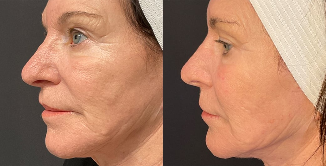 Morpheus8 Before and After Photos of Dark Haired Woman