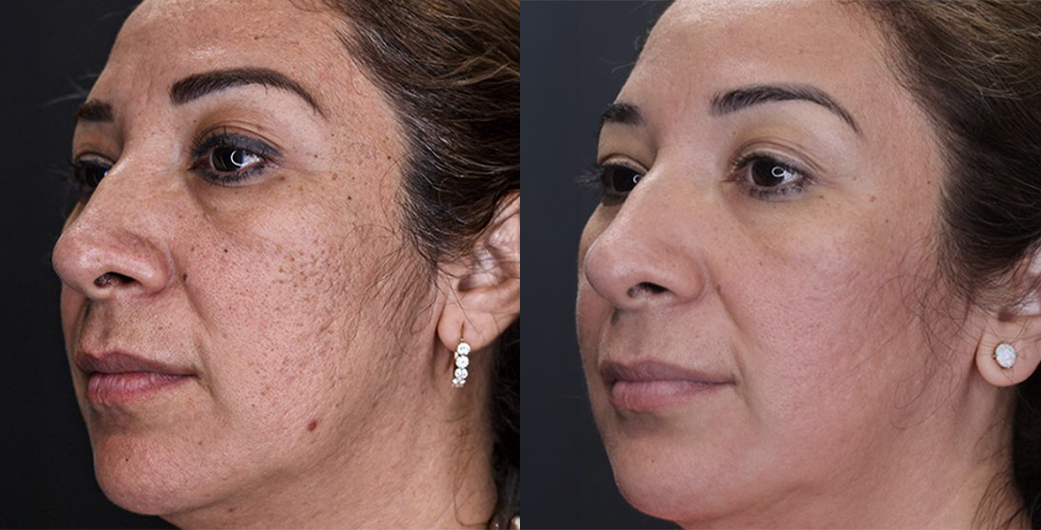 Morpheus8 Before and After Photos of Brunette Woman