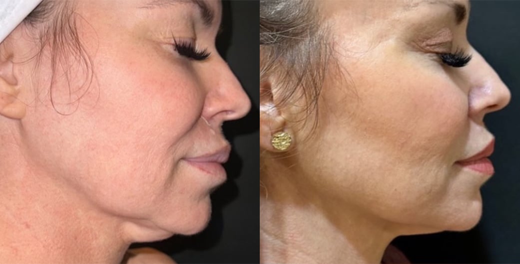 Morpheus8 Before and After Photos of Brunette Woman