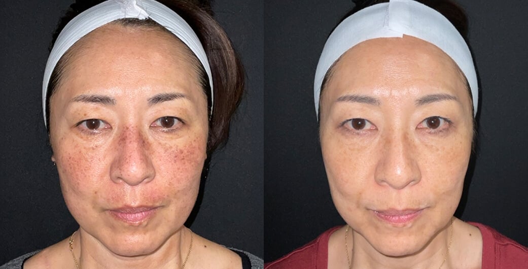 Before and After Photos of a Woman Who Received BBL Treatment