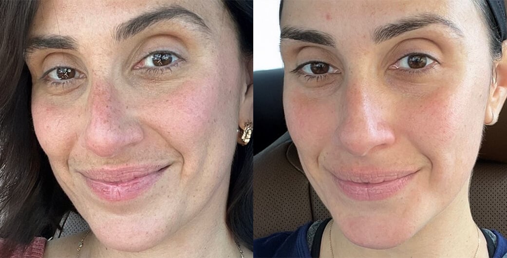 Before and After Photos of a Woman Who Received BBL Treatment