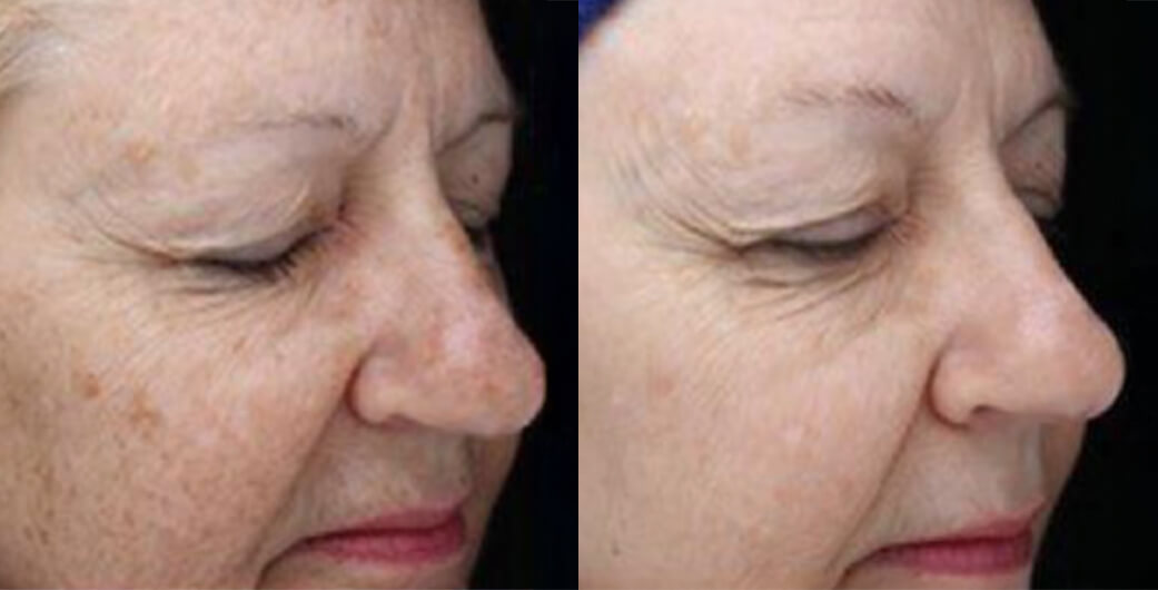 Before and After Photos of a Woman Who Received BBL Treatment