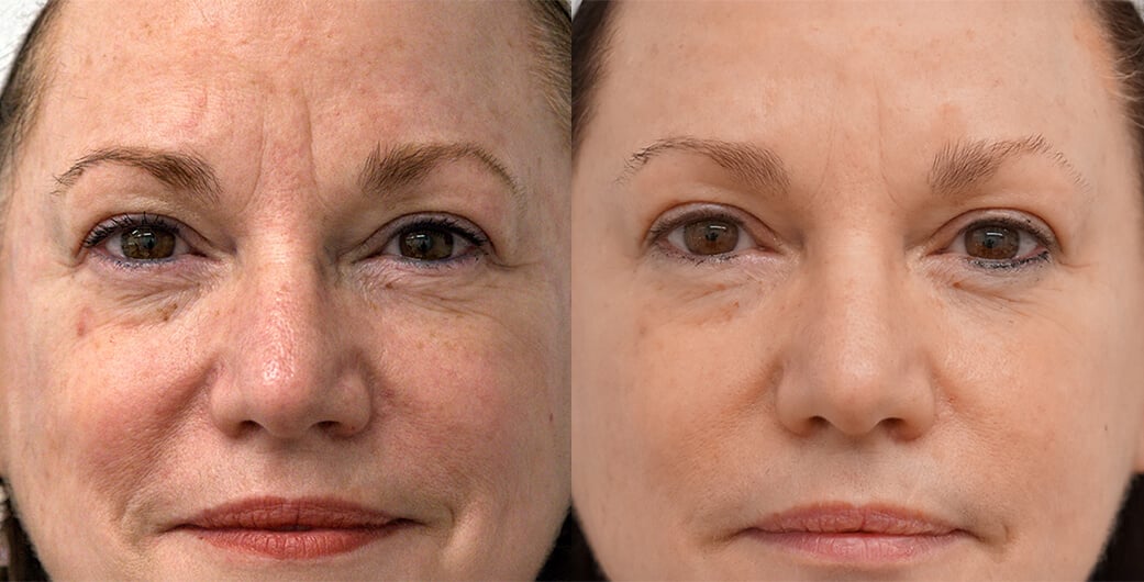Before and After Photos of a Woman Who Received BBL Treatment