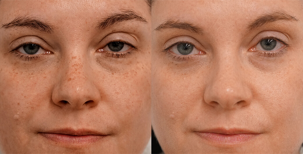 Before and After Photos of a Woman Who Received BBL Treatment
