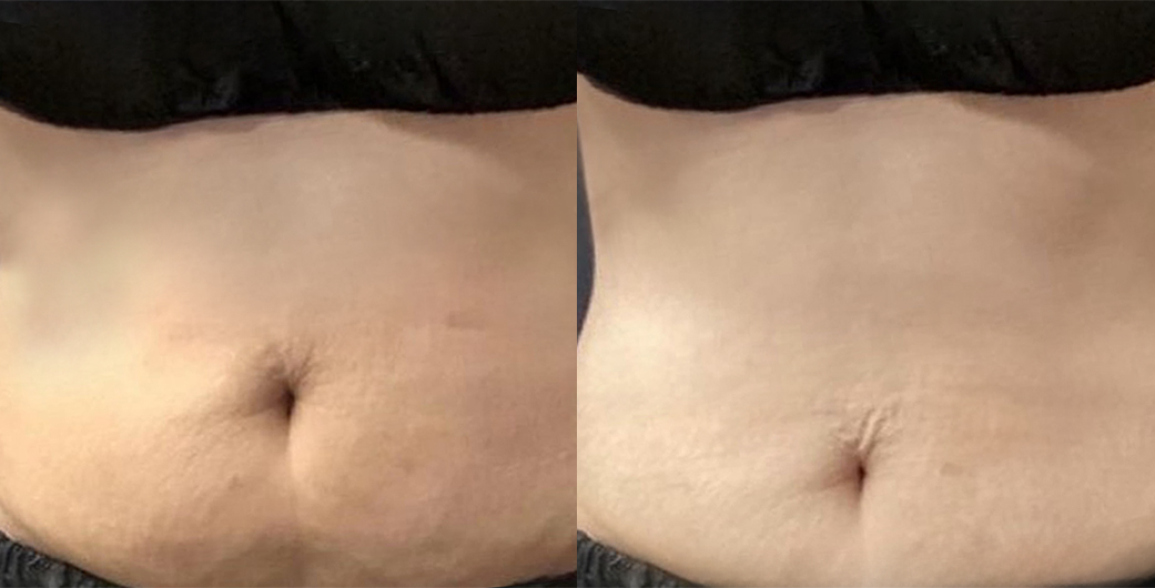 Abdomen before and after CoolSculpting treatment