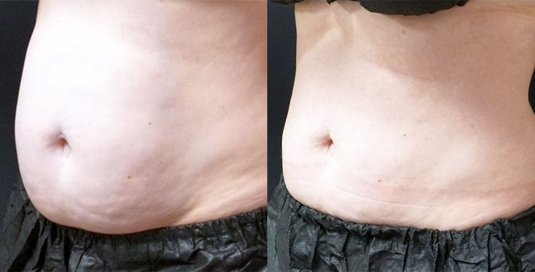 Abdomen before and after CoolSculpting treatment