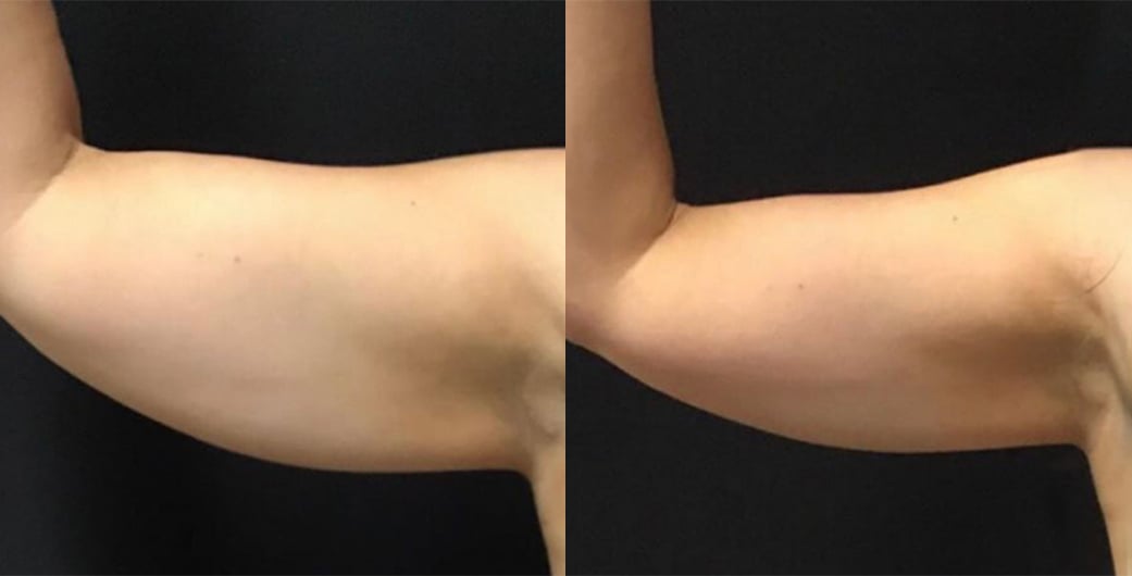 Upper arm before and after CoolSculpting treatment