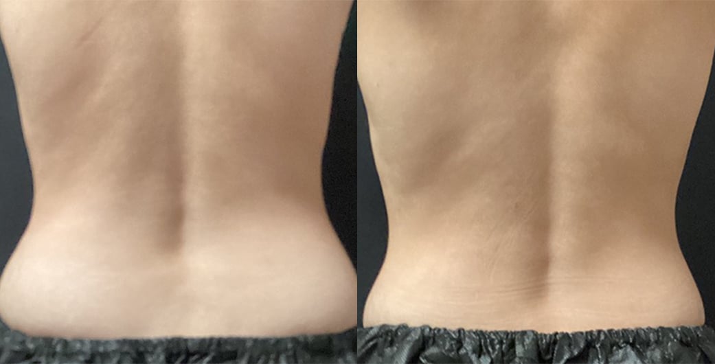 Back before and after CoolSculpting treatment