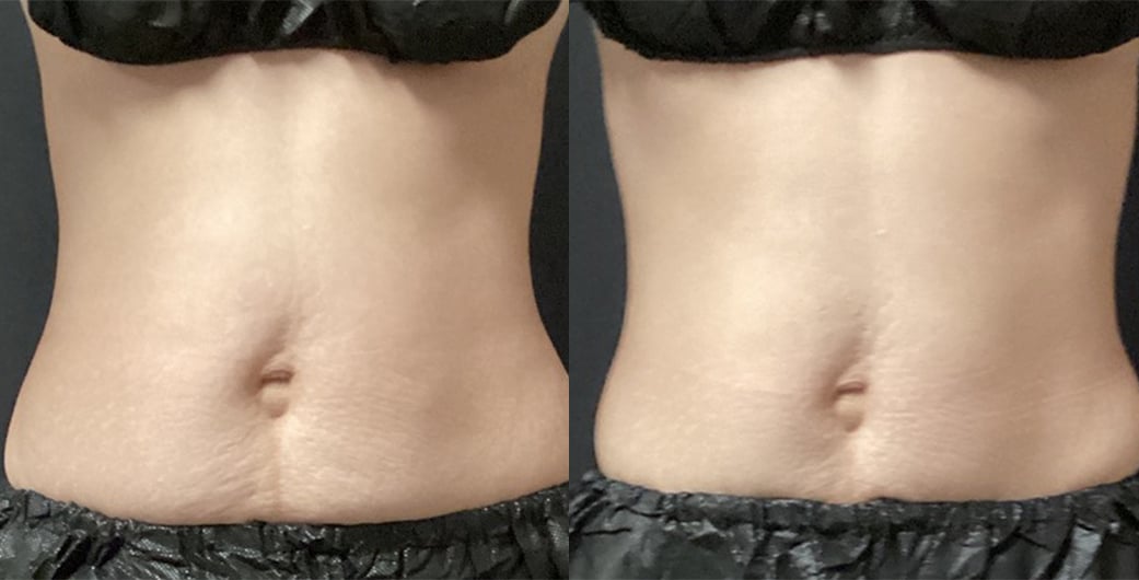 Abdomen before and after CoolSculpting treatment