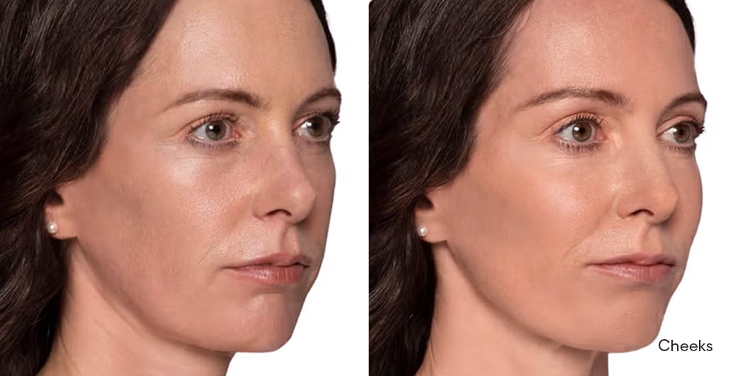 Before - and -After - Filler - Cheeks - 003