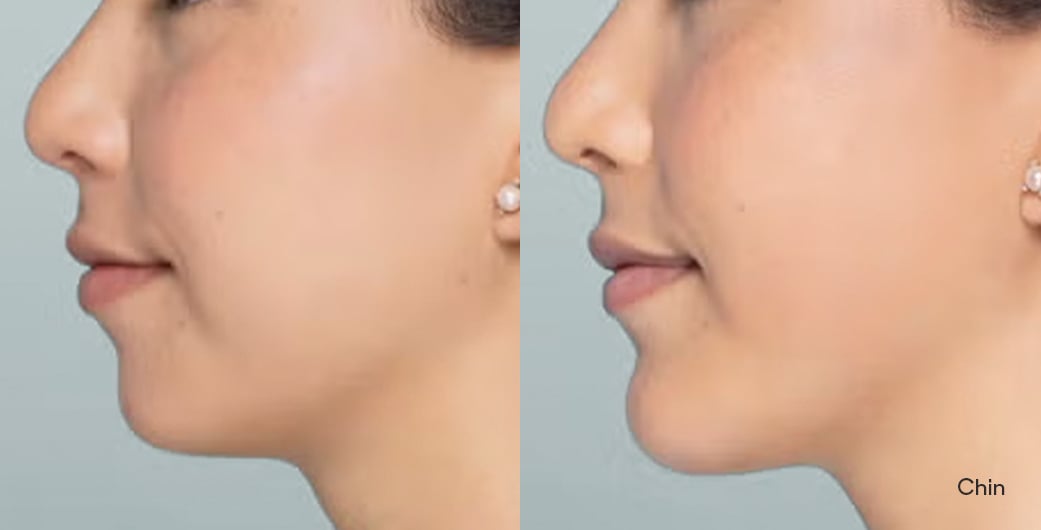 Before - and -After - Filler - Chin - 001