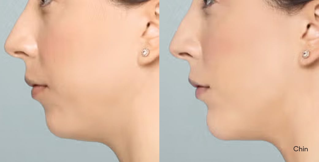 Before - and -After - Filler - Chin - 002