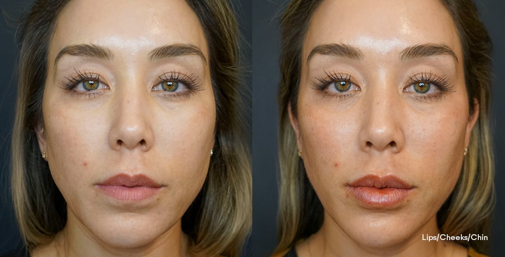 Before - and -After - Filler - FullFacial - 001