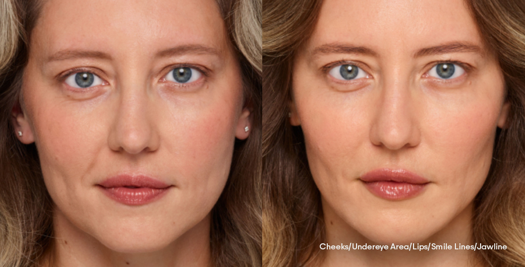 Before - and -After - Filler - FullFacial - 003
