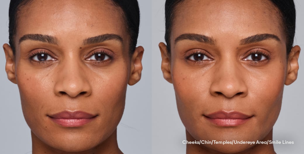 Before - and -After - Filler - FullFacial - 004