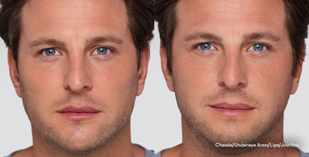 Before - and -After - Filler - FullFacial - 005