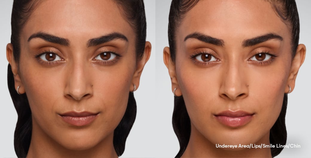 Before - and -After - Filler - FullFacial - 006