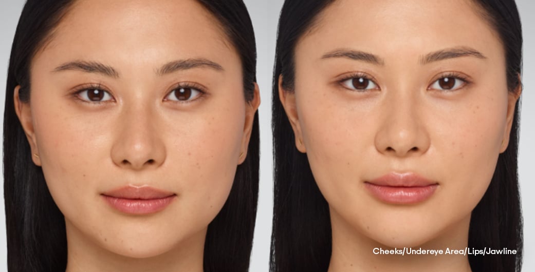 Before - and -After - Filler - FullFacial - 007