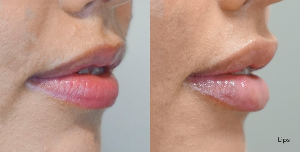 Before - and -After - Filler - Lips - 001