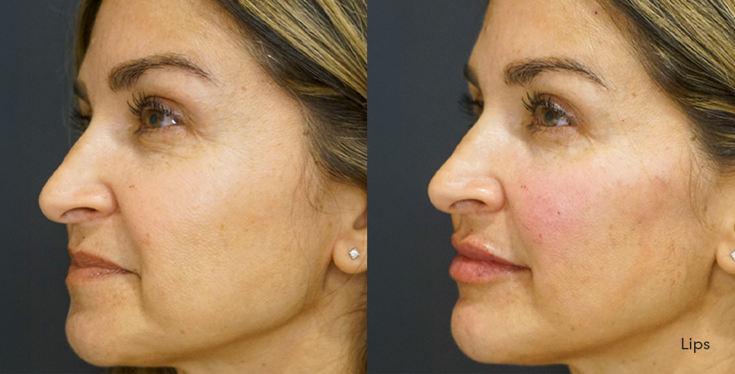 Before - and -After - Filler - Lips - 002