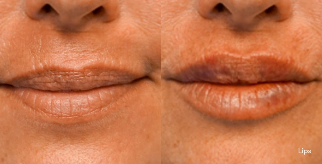 Before - and -After - Filler - Lips - 003