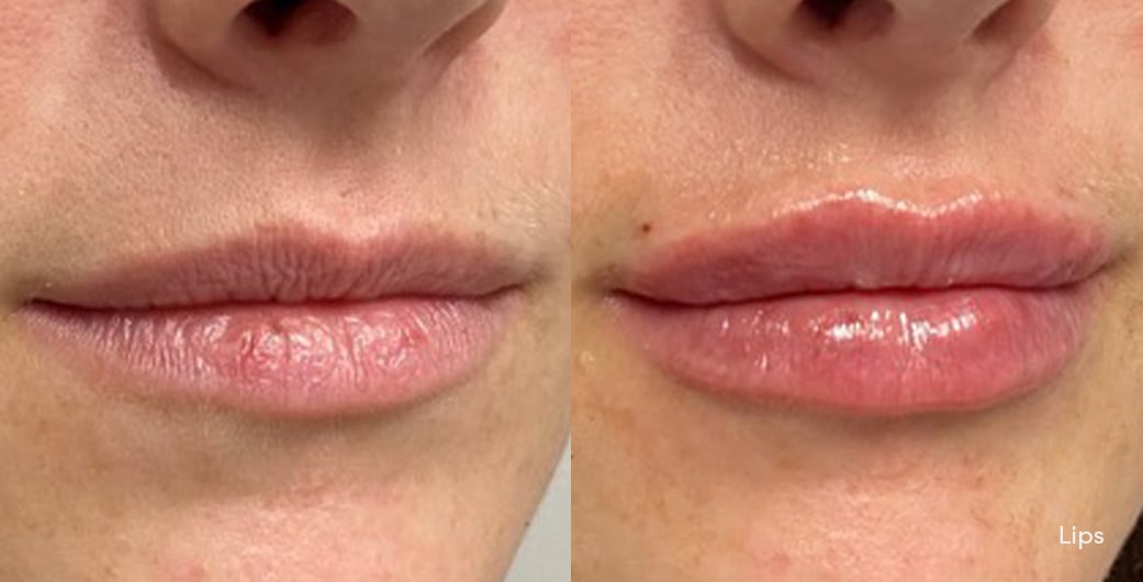 Before - and -After - Filler - Lips - 004