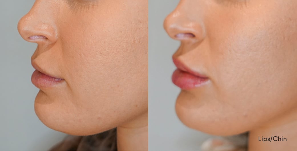Before - and -After - Filler - LowerFace - 001