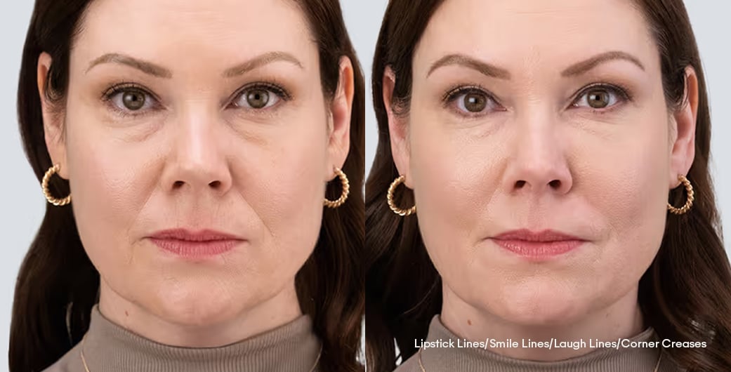Before - and -After - Filler - LowerFace - 003