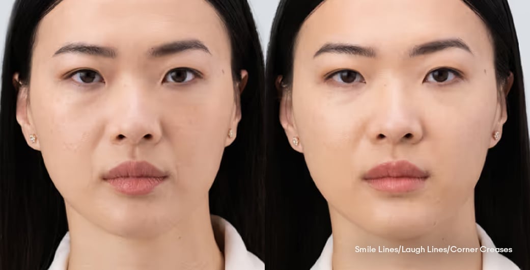 Before - and -After - Filler - LowerFace - 004
