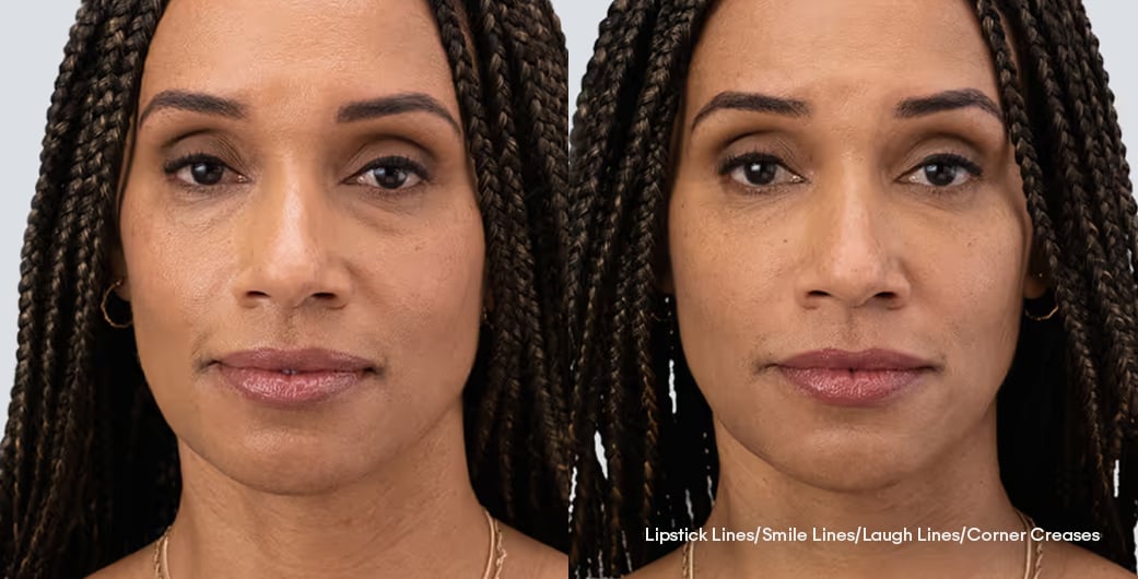 Before - and -After - Filler - LowerFace - 005