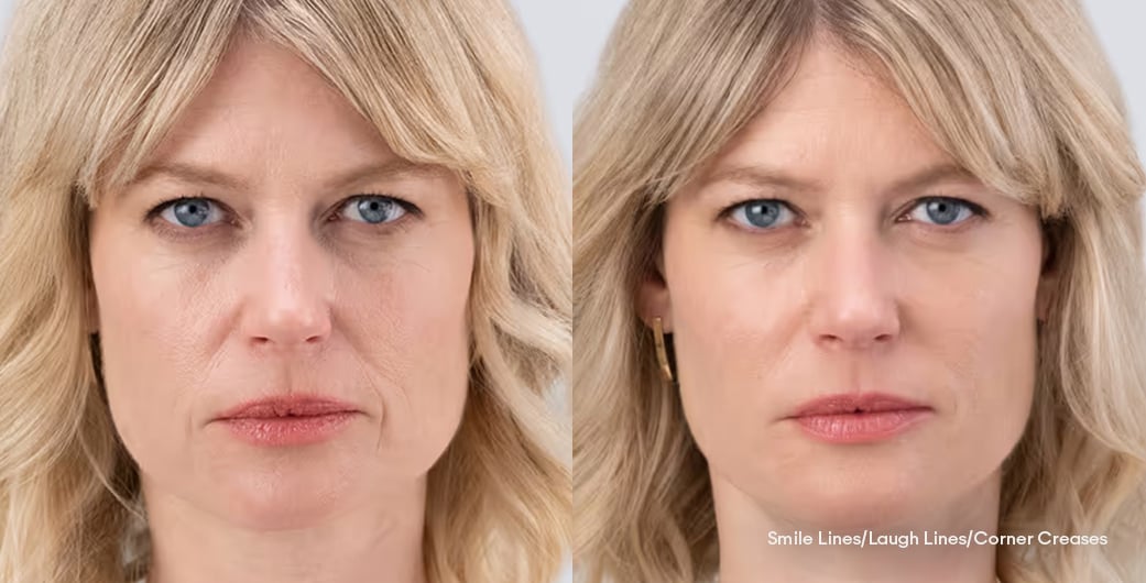 Before - and -After - Filler - LowerFace - 006