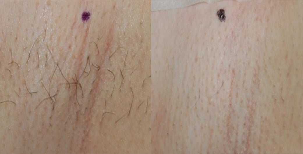 Before - and -After - LHR -001-1