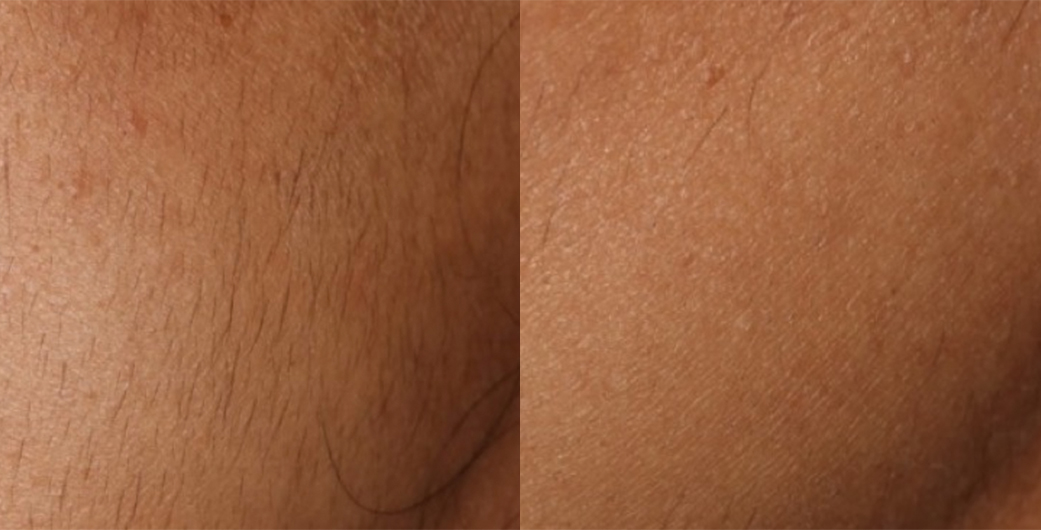 Before - and -After - LHR -002-1