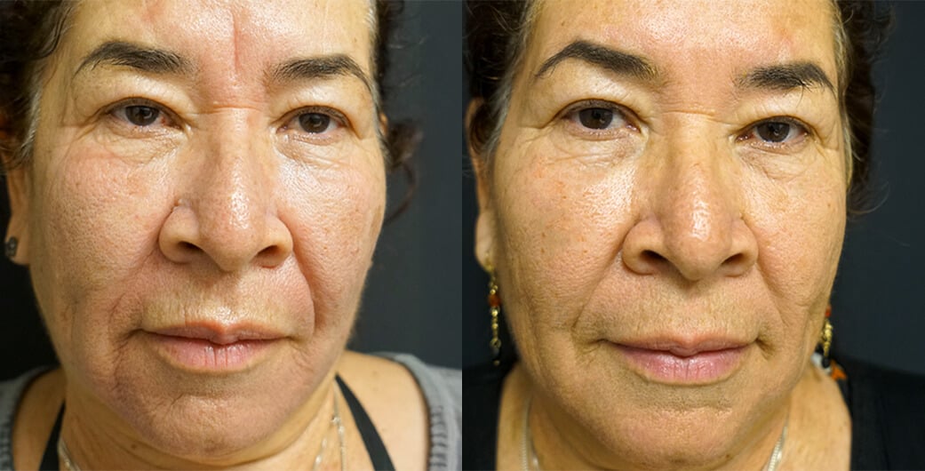 Before and After Photos of a Woman Who Received Laser Resurfacing Treatment