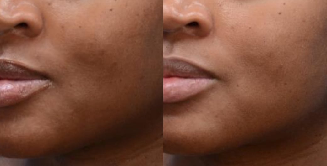 Before and After Photos of a Woman Who Received Laser Resurfacing Treatment
