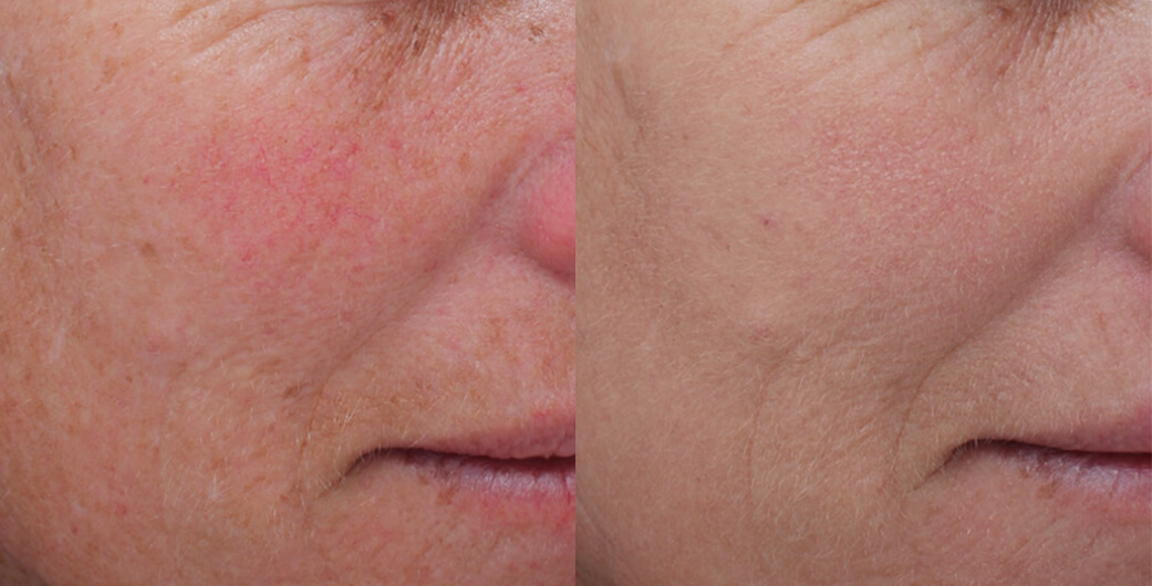 Before and After Photos of a Woman Who Received Laser Resurfacing Treatment
