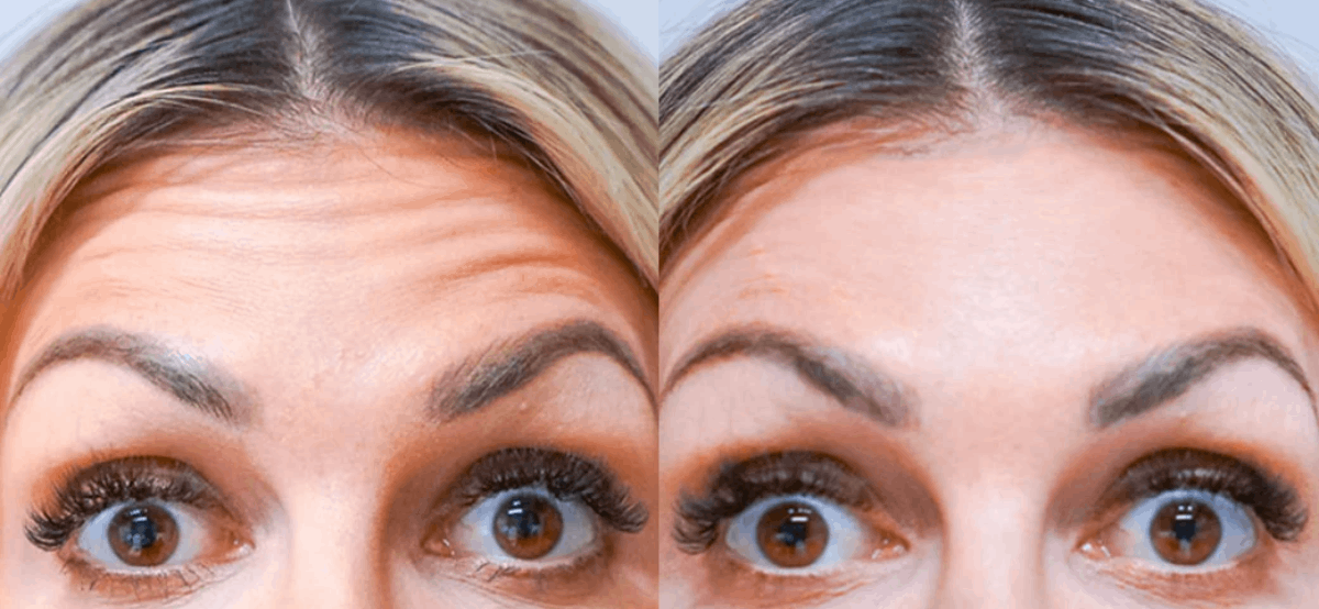 Botox01