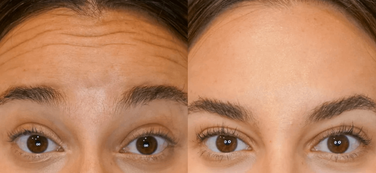 Botox03