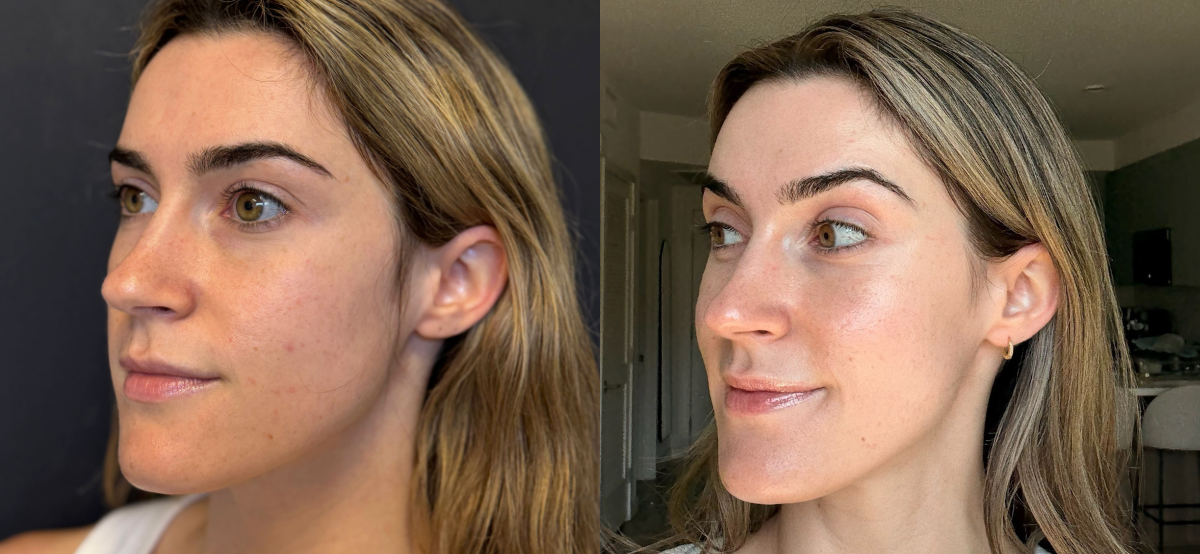Microneedling Before and After