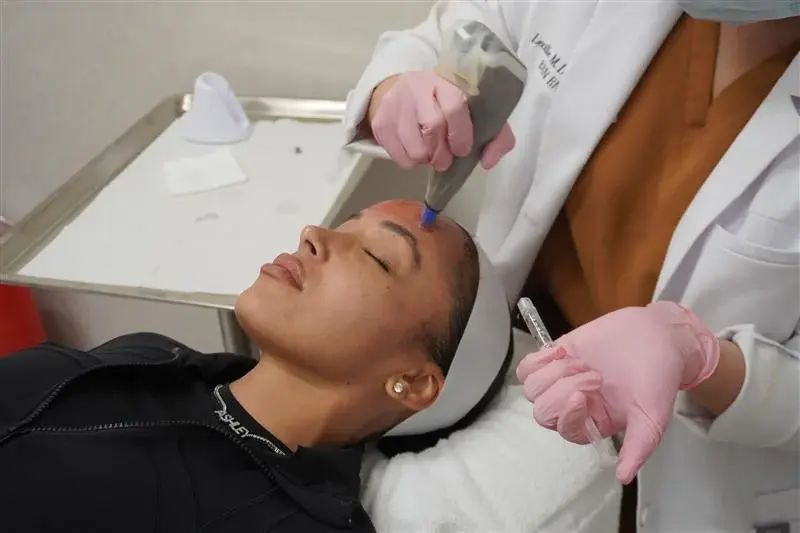 microneedling-25off